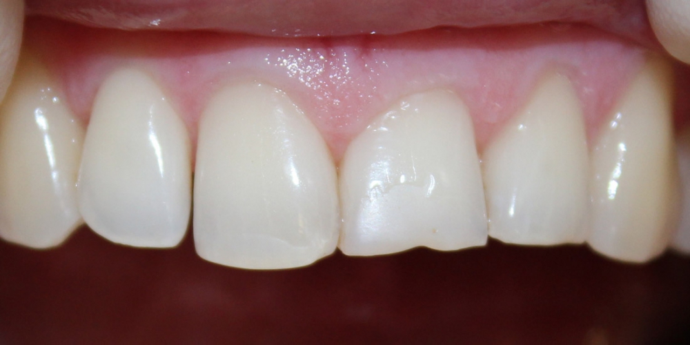 Композитная реставрация сколов зубов
