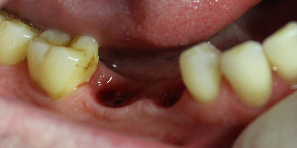  Восстановление двух отсутствующих зубов единичными коронками на диоксиде циркония