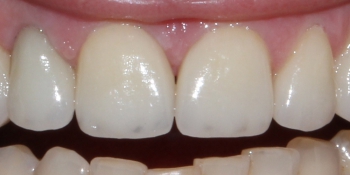 Безметалловые коронки, виниры фронтальной группы зубов фото после лечения