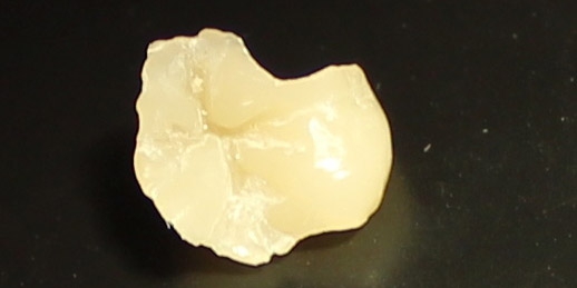  Восстановление второго нижнего жевательного зуба слева композитной вкладкой