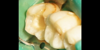Восстановление второго нижнего жевательного зуба слева композитной вкладкой фото до лечения