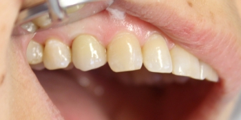 Восстановление зуба коронкой на имплантате фото после лечения