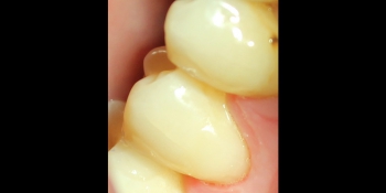 Устранение пришеечного кариеса второго нижнего малого жевательного зуба пломбой фото после лечения