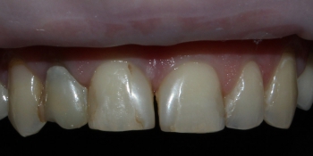 Безметалловые коронки, виниры фронтальной группы зубов фото до лечения