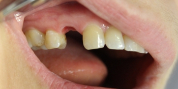 Восстановление зуба коронкой на имплантате фото до лечения