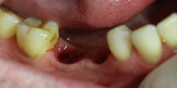 Восстановление двух отсутствующих зубов единичными коронками на диоксиде циркония фото до лечения