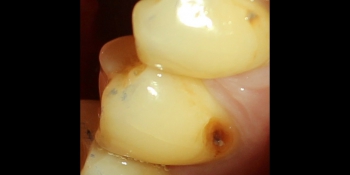 Устранение пришеечного кариеса второго нижнего малого жевательного зуба пломбой фото до лечения