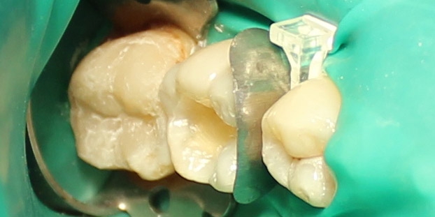  Восстановление второго нижнего жевательного зуба слева композитной вкладкой