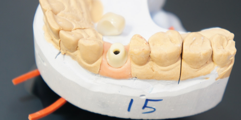  Восстановление зуба коронкой на имплантате