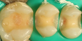 Восстановление жевательных верхних правых зубов композитными вкладками фото до лечения