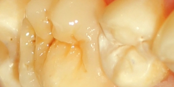 Восстановление зуба композитной вкладкой фото после лечения